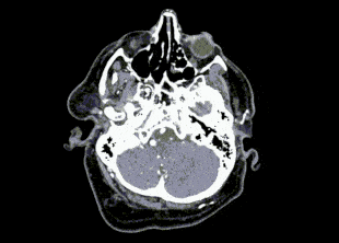 A new algorithm has helped radiologists find an aneurysm in the brain