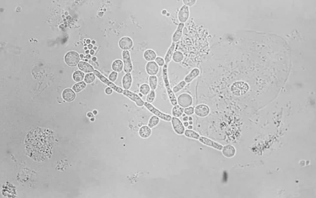 A fungus can complicate the COVID-19 pandemic: it was detected in four countries