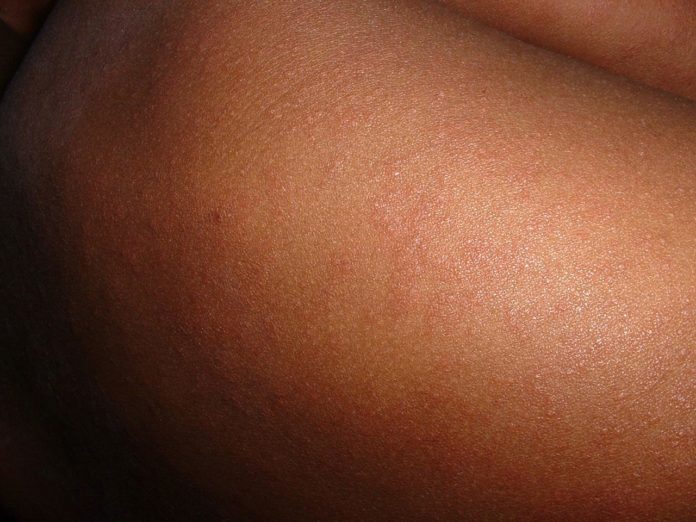 Measles kills more than 200,000 people in 2019 and reaches its highest level in 23 years