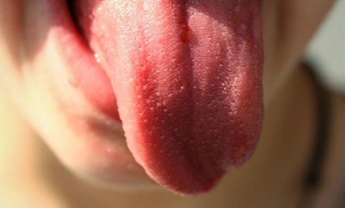 Covid Tongue: British experts identify a new symptom of coronavirus infection