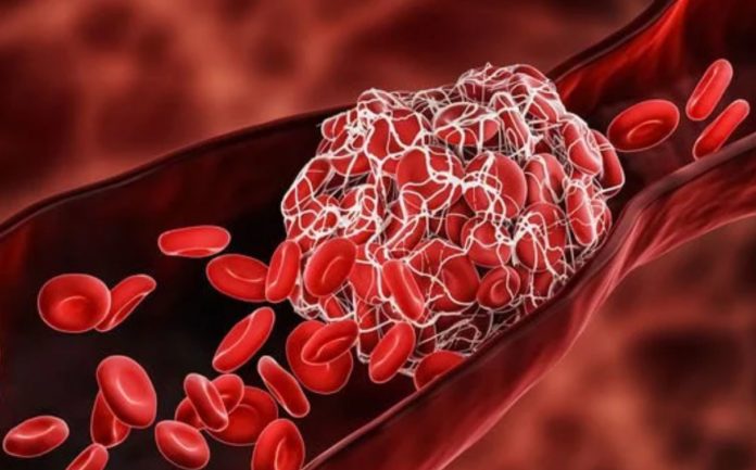 How do we know if we have a blood clot in our leg? 7 key symptoms of a blood clot