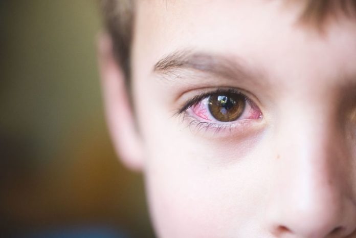 Conjunctivitis symptoms: COVID-19 or another viral or bacterial infection