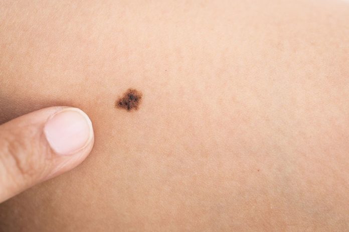 Five Warning Signs of Cancerous Moles, According to a Doctor