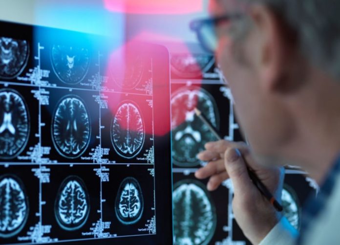 A Mysterious Brain Disease Baffles Canadian Doctors