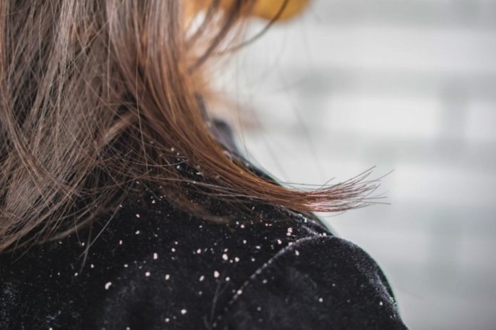 British experts say Dandruff could be a symptom of Parkinson's disease