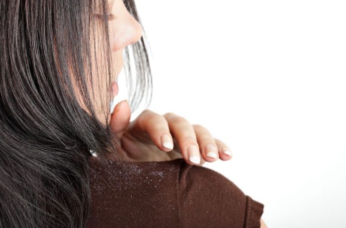 Disease specialist reports the most common reason for Dandruff and how to treat your flaky and itchy scalp