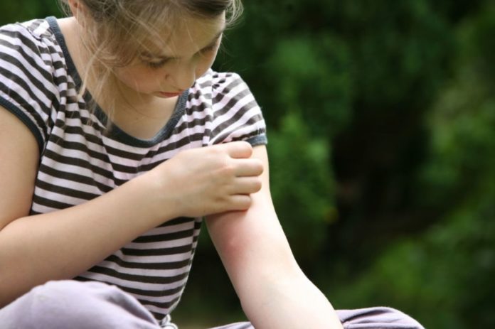 Here's how to spot 10 most common bad bug bites and stings