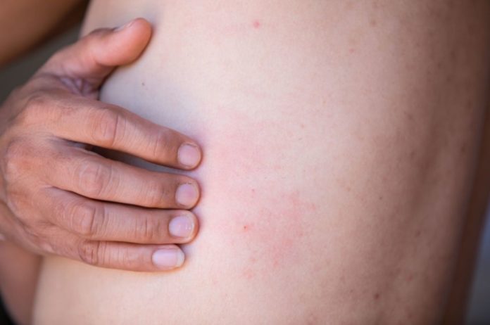 Shingles: If you have 3 symptoms, you should see a doctor