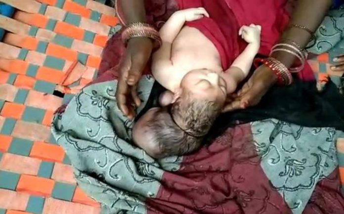 Woman gives birth to a three-headed baby in India