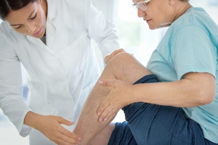 Varicose veins: why do they appear and how to fix them?