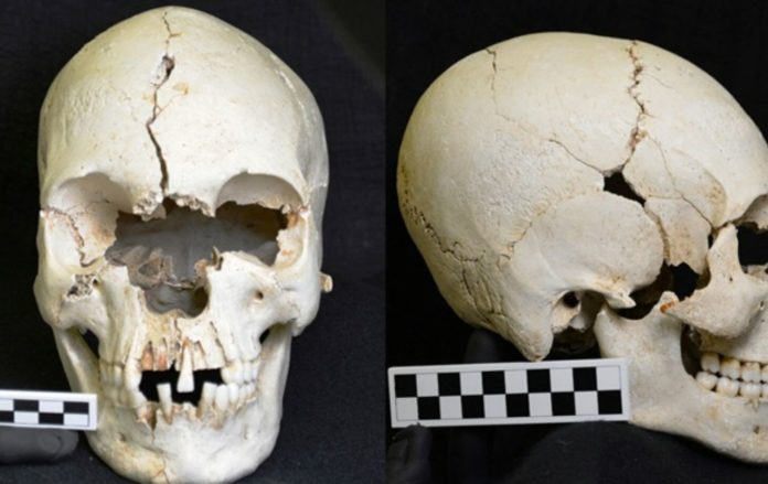 200-year-old 'Skull of a Leprosy Patient' discovered on Caribbean island
