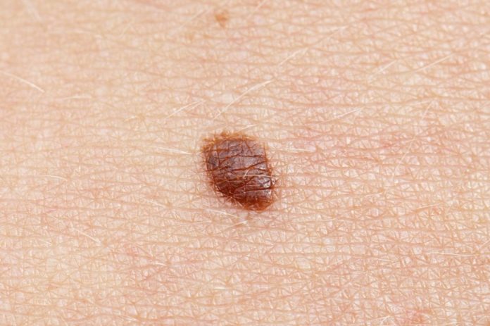 Study uncovers a new way to predict and treat Metastatic melanoma early