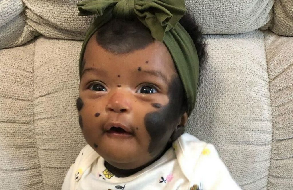 A girl with rare dark spots born in the US