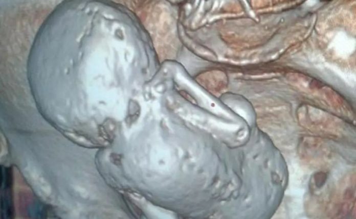 Pharaoh Mummy? A fossilized unborn child found in 73-years old woman's belly