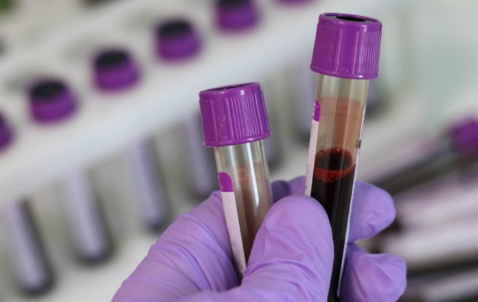 Blood screening may predict whether COVID patients would live or die