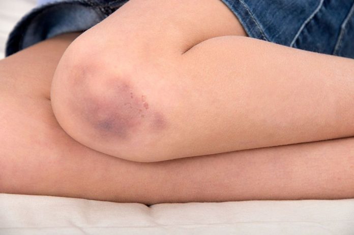 Blood clot skin changes are different to those caused by bruises - experts