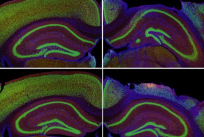 A New Therapeutic Approach Boosts Immunity After Brain Injury, Stroke