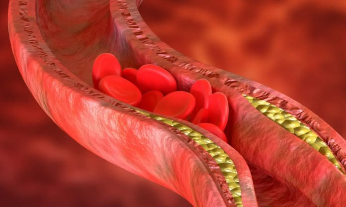 Atherosclerosis: Vascular damage has a direct line to the brain