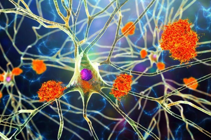 Finally, We Know How to Eliminate Build-up of Toxic Proteins in Dementia