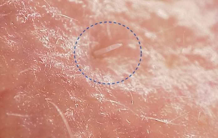 Neue Studie enthüllt das geheime Leben von Hautmilben