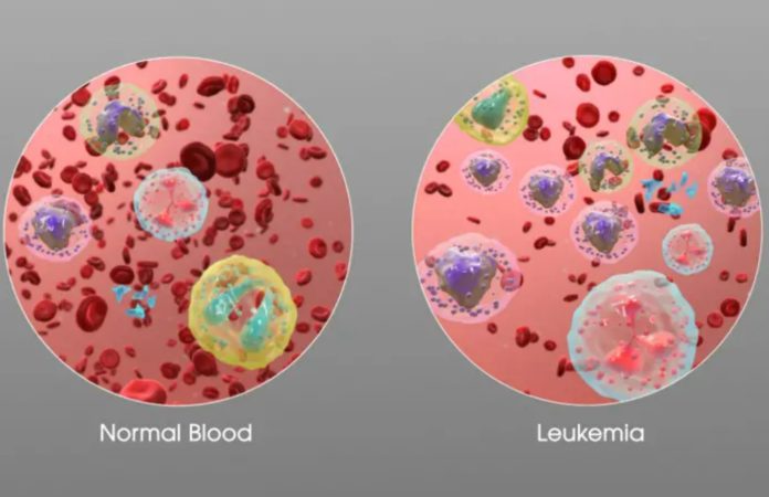This New Approach Makes Leukemia Cancer Cells Harmless