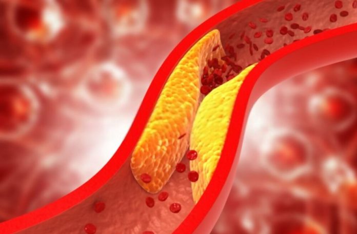 An Unusual Sign That Could Signal Dangerously High Cholesterol Levels