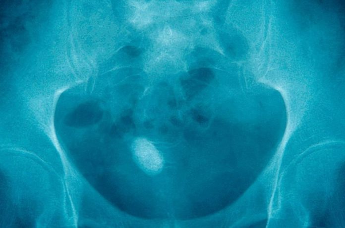What Makes Kidney Stone Reappear And How You Can Prevent That - New Study Reveals