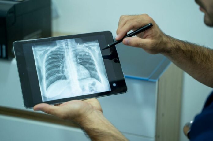 Now A Single Chest X-ray Can Predict The 10-year Risk Of Death From Heart Attack Or Stroke