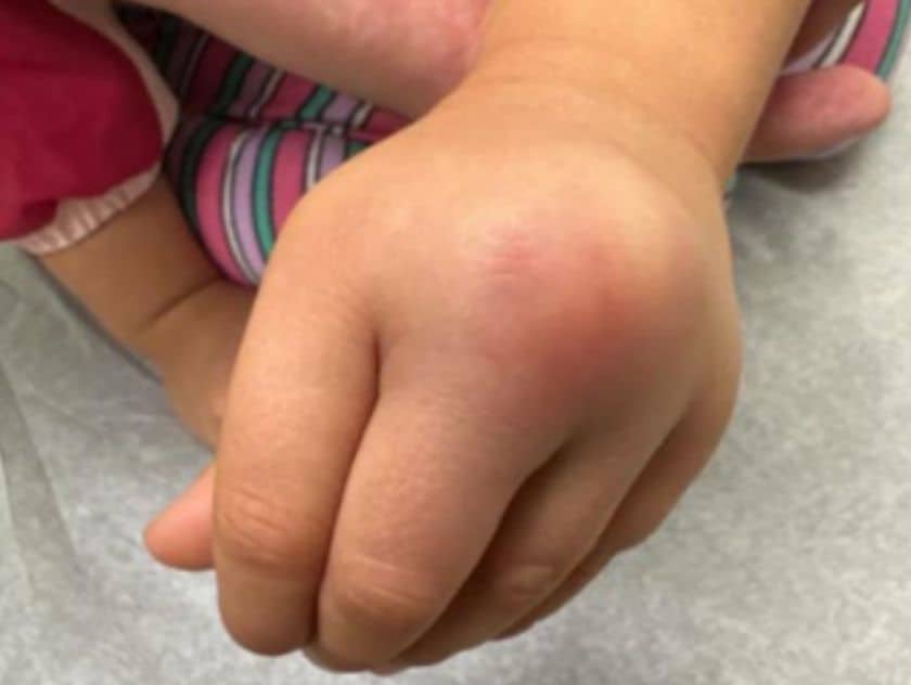 Iguana Cake Thief Leaves Toddler with Rare Infection: A Cautionary Tale