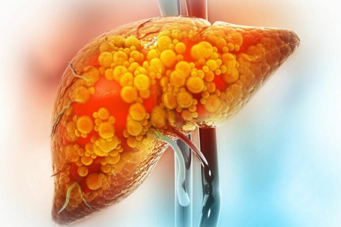Scientists Develop a Unique Supramolecule that Removes Cholesterol Leading to Advanced Fatty Liver Disease